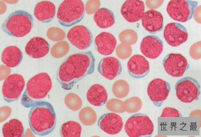 急性淋巴细胞白血病