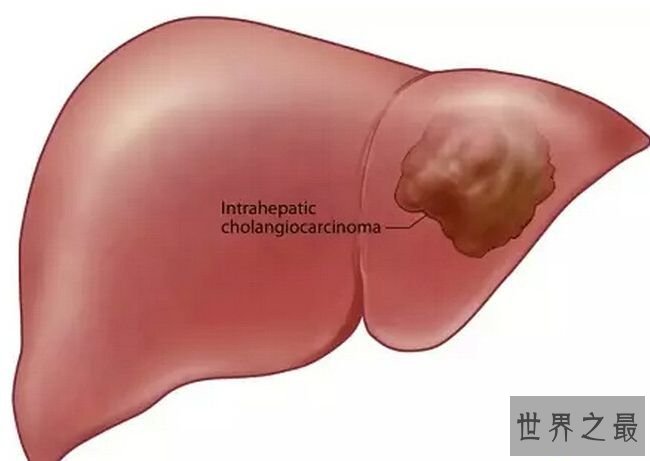 肝内胆管细胞癌