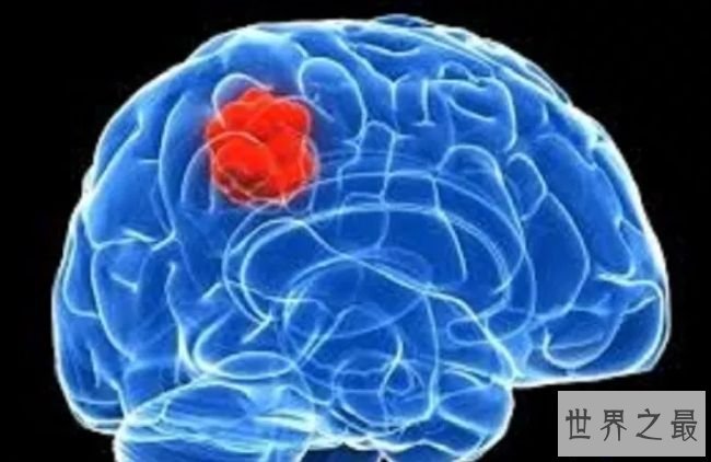 神经系统和脑癌