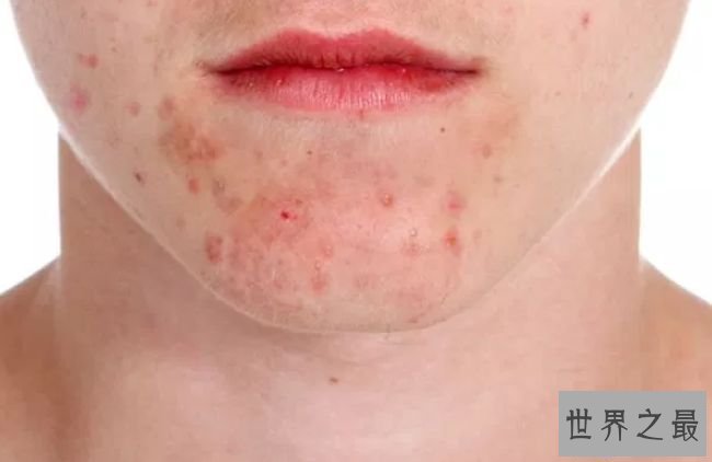 治疗痤疮、牛皮癣等皮肤病