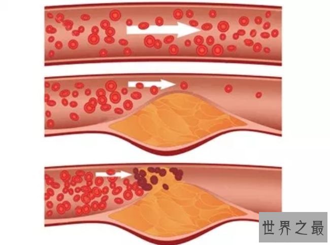 升高胆固醇