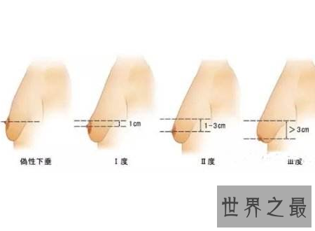 【图】下垂乳房女人必须知道的颐养身材诀窍