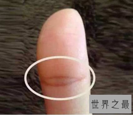 指纹是孔雀眼型