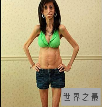 【图】世界上最瘦的人 体重竟犹如一个重生婴儿