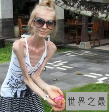【图】世界上最瘦的人 体重竟犹如一个重生婴儿