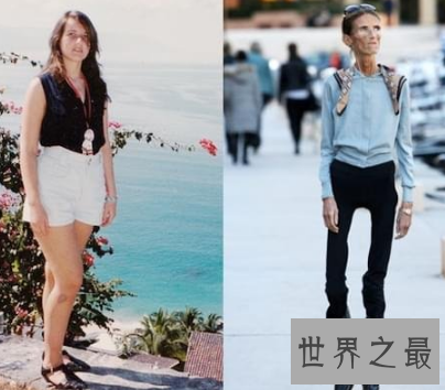 【图】世界上最瘦的人 体重竟犹如一个重生婴儿