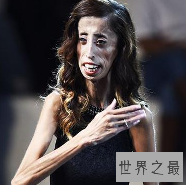 【图】世界上最瘦的人 体重竟犹如一个重生婴儿