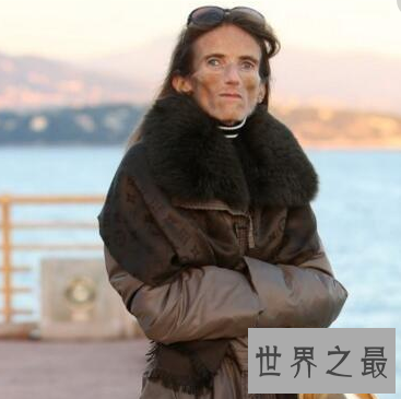 【图】世界上最瘦的人 体重竟犹如一个重生婴儿