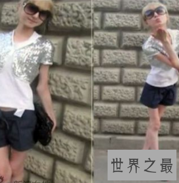 【图】世界上最瘦的人 体重竟犹如一个重生婴儿