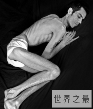 【图】世界上最瘦的人 体重竟犹如一个重生婴儿