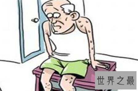 【图】盗汗是什么意思为什么会出现盗汗该怎样去预防