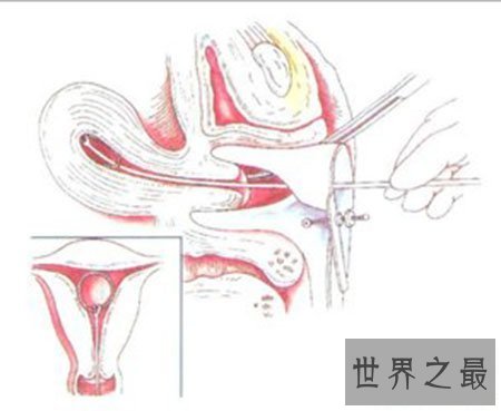【图】节育环图片到底是什么样子 就仅仅是一个环吗