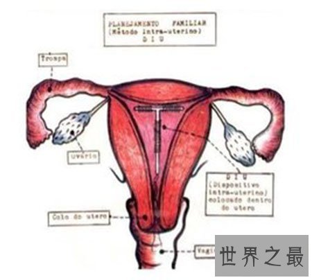 【图】节育环图片到底是什么样子 就仅仅是一个环吗