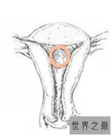 【图】节育环图片到底是什么样子 就仅仅是一个环吗