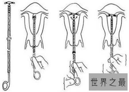 【图】节育环图片到底是什么样子 就仅仅是一个环吗