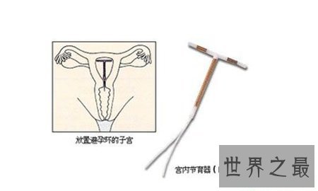 【图】节育环图片到底是什么样子 就仅仅是一个环吗