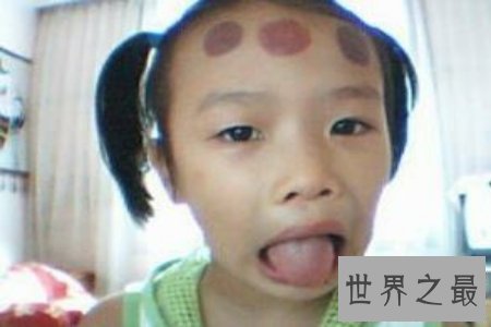 【图】扭痧之法 人人都可能学会 你也值得领有