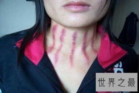 【图】扭痧之法 人人都可能学会 你也值得领有