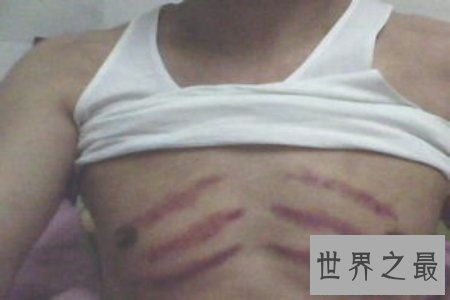 【图】扭痧之法 人人都可能学会 你也值得领有