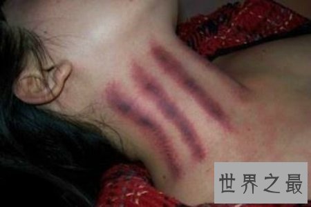【图】扭痧之法 人人都可能学会 你也值得领有