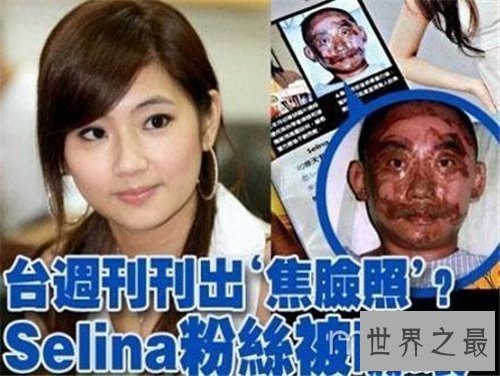 【图】任家萱烧伤图片对比照 任家萱张承中离婚缘由