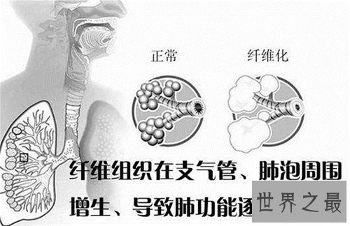 【图】肺部纤维化病因原由引见 症状以及治疗方法引见
