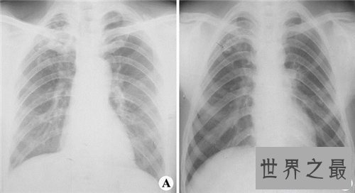 【图】肺部纤维化病因原由引见 症状以及治疗方法引见