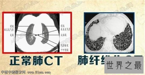 【图】肺部纤维化病因原由引见 症状以及治疗方法引见