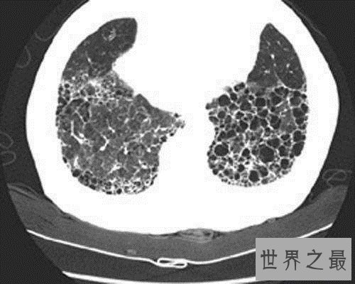 【图】肺部纤维化病因原由引见 症状以及治疗方法引见