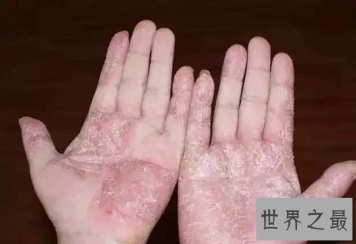 【图】春天越近手心爆皮越痒这是手脱皮的征兆手脱皮