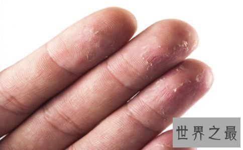 【图】春天越近手心爆皮越痒这是手脱皮的征兆手脱皮