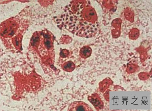 【图】女性男性的最大克星除了癌症还有淋病淋病的症