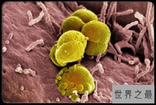 【图】女性男性的最大克星除了癌症还有淋病淋病的症