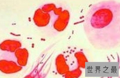 【图】女性男性的最大克星除了癌症还有淋病淋病的症