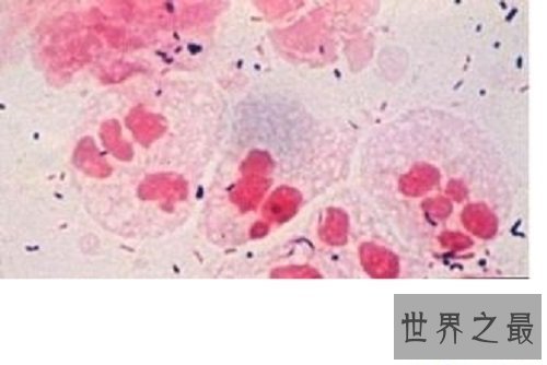 【图】女性男性的最大克星除了癌症还有淋病淋病的症