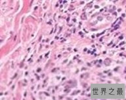 【图】女性男性的最大克星除了癌症还有淋病淋病的症