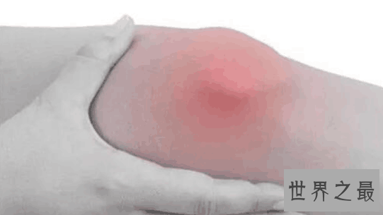 【图】骨膜炎要怎样治疗你知道日常应该怎样护理么