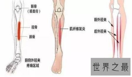【图】骨膜炎要怎样治疗你知道日常应该怎样护理么