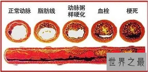 【图】硬化血管的食物及效用 想要寿命长必须先预防