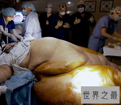 【图】世界第一胖体重高达10多个一般成人的分量