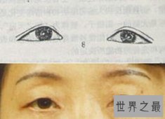 【图】一种常见的生理现象三角眼 我们该怎么矫正