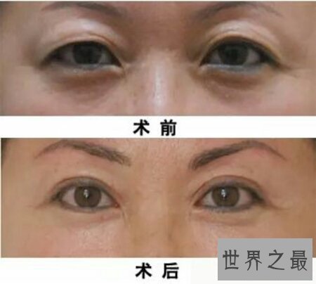 【图】一种常见的生理现象三角眼 咱们该怎样矫正