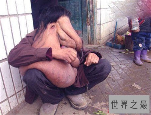 【图】最丑的男人脸部长瘤五官变样 乌干达最丑男人靠