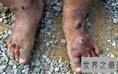 【图】光听名字就足以让人谈虎色变的世界五大绝症