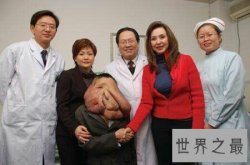 【图】什么是象面人世界上最大的面部肿瘤患者叫黄春