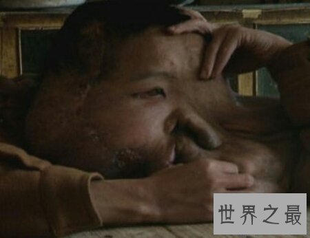 【图】什么是象面人间界上最大的面部肿瘤患者叫黄春