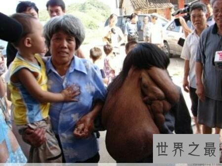 【图】什么是象面人间界上最大的面部肿瘤患者叫黄春