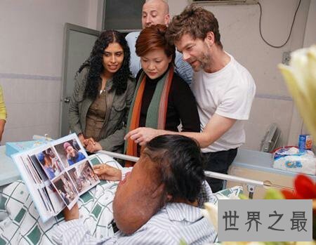 【图】什么是象面人间界上最大的面部肿瘤患者叫黄春