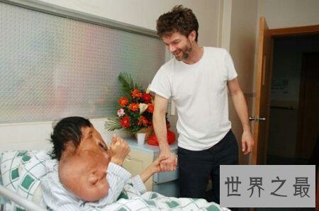 【图】什么是象面人间界上最大的面部肿瘤患者叫黄春