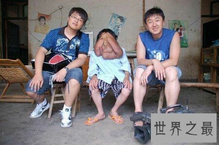 【图】什么是象面人间界上最大的面部肿瘤患者叫黄春